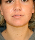 Feel Beautiful - Liposuction Lower Cheeks - Before Photo