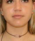 Feel Beautiful - Liposuction Lower Cheeks - After Photo