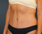 Feel Beautiful - Tummy-Tuck-for-loose-skin - After Photo