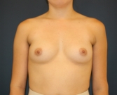 Feel Beautiful - 650 ml Ultra High Profile Breast Implants - Before Photo