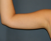 Feel Beautiful - Arm Lipo-Reduction San Diego - After Photo
