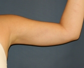 Feel Beautiful - Arm Liposuction San Diego - After Photo
