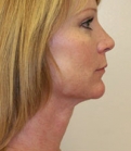 Feel Beautiful - Necklift Case 2 - After Photo