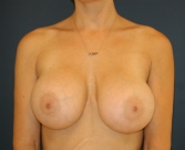 Feel Beautiful - 590cc breast implants - After Photo