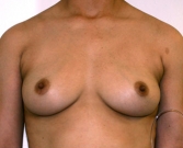 Feel Beautiful - Breast Augmentation Case 16 - Before Photo