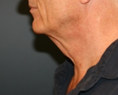 Feel Beautiful - Neck Lift San Diego 36 - Before Photo