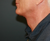 Feel Beautiful - Neck Lift San Diego 36 - After Photo