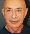 Feel Beautiful - Facelift for Men San Diego - After Photo