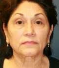 Feel Beautiful - Face Lift San Diego 44 - Before Photo