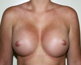 Feel Beautiful - Breast Augmentation Case 17 - After Photo