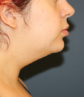 Feel Beautiful - Neck Liposuction and Weight Loss - Before Photo