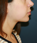 Feel Beautiful - Neck Liposuction and Weight Loss - After Photo