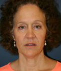 Feel Beautiful - Face Lift San Diego 45 - Before Photo
