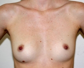 Feel Beautiful - Breast Augmentation Case 18 - Before Photo