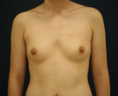 Feel Beautiful - Natural Breast Augmentation 10 - Before Photo