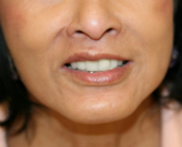 Feel Beautiful - Upper Lip Lift Chin Implant - After Photo