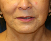 Feel Beautiful - Chin Implant and Upper Lip Lift - Before Photo