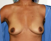 Feel Beautiful - Breast Augmentation Case 19 - Before Photo