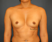 Feel Beautiful - Breast Augmentation TMPX 405 - Before Photo