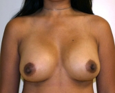 Feel Beautiful - Breast Augmentation Case 19 - After Photo