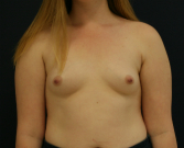 Feel Beautiful - Breast Augmentation-455cc Sientra - Before Photo
