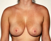 Feel Beautiful - Breast Augmentation Case 20 - Before Photo