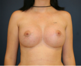 Feel Beautiful - Breast Augmentation 650cc - After Photo