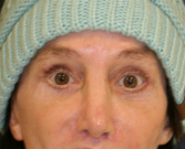 Feel Beautiful - Revision Eyelid Surgery - After Photo