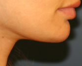 Feel Beautiful - Liposuction fat under chin - After Photo