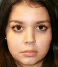 Feel Beautiful - Tip Rhinoplasty in Office - After Photo