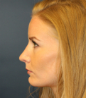 Feel Beautiful - Revision Rhinoplasty 28 - After Photo