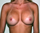 Feel Beautiful - Breast Augmentation Case 24 - After Photo