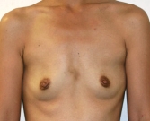 Feel Beautiful - Breast Augmentation Case 28 - Before Photo