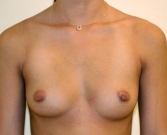 Feel Beautiful - Breast Augmentation Case 30 - Before Photo