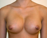 Feel Beautiful - Breast Augmentation Case 30 - After Photo