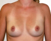 Feel Beautiful - Breast Augmentation Case 31 - Before Photo