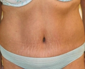 Feel Beautiful - Tummy Tuck Case 6 - After Photo