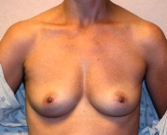 Feel Beautiful - Breast Augmentation Case 33 - Before Photo