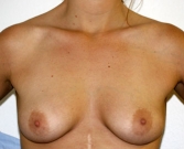 Feel Beautiful - Breast Augmentation Case 34 - Before Photo