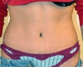 Feel Beautiful - Tummy Tuck Case 2 - After Photo