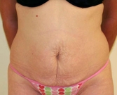 Feel Beautiful - Tummy Tuck Case 7 - Before Photo