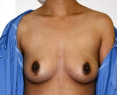 Feel Beautiful - Breast Augmentation Case 39 - Before Photo