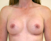 Feel Beautiful - Breast Augmentation Case 40 - After Photo