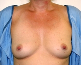 Feel Beautiful - Breast Augmentation Case 41 - Before Photo