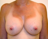 Feel Beautiful - Breast Augmentation Case 41 - After Photo