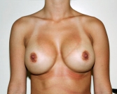 Feel Beautiful - Breast Augmentation Case 43 - After Photo