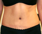 Feel Beautiful - Tummy Tuck Case 8 - After Photo