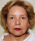 Feel Beautiful - Facelift Case 4 - After Photo