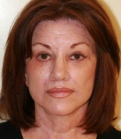 Feel Beautiful - Facelift Case 3 - After Photo