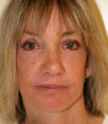 Feel Beautiful - Facelift Case 8 - After Photo